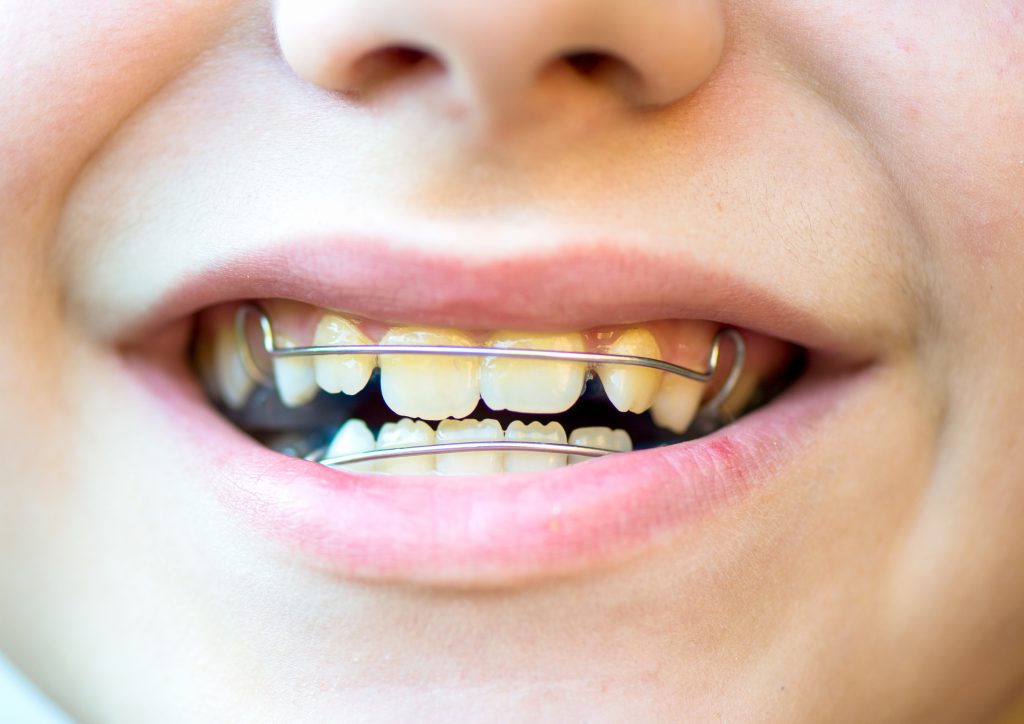 Kieferorthopädie - zu sehen ist eine Behandlungssituation in der Praxis